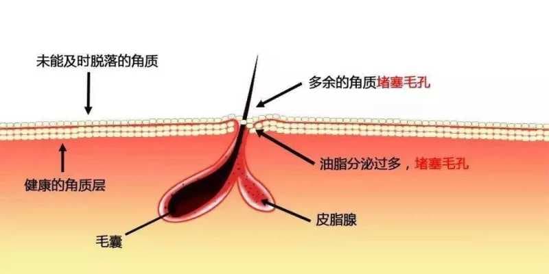 如何解救「大油田」？清爽男士必备的控油答案在此